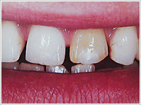 審美治療患者様BEFORE